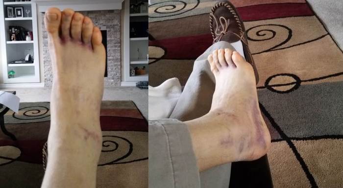 Ankle Montage
